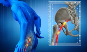 Overcome Sciatica: Understand, Manage, and Conquer Your Pain